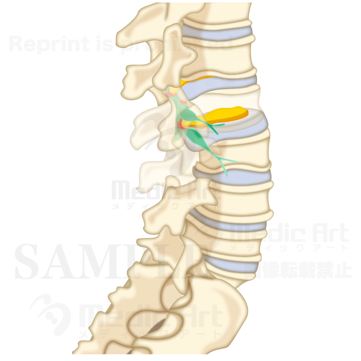 The lumbar disc herniation