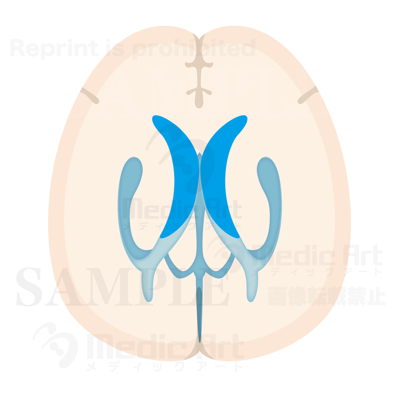 Horizental section of Cerebralventricle1(Judging from superior aspect)