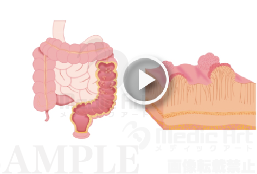 【大腸の病気】 非腫瘍性の大腸ポリープ