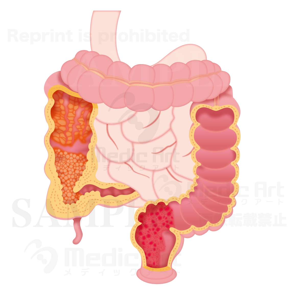 Ulcerative colitis and Crohn's disease