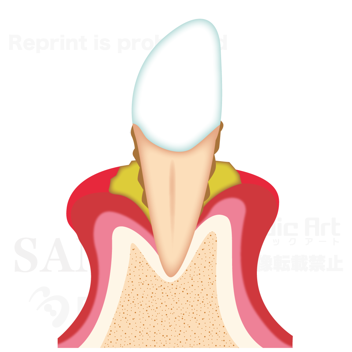The progression of periodontal diseases. 3 (moderate periodontitis)