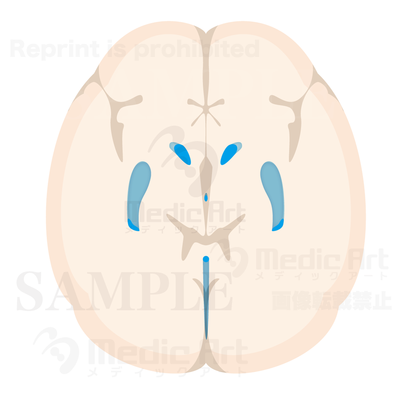 Horizental section of Cerebralventricle3(Judging from superior aspect)