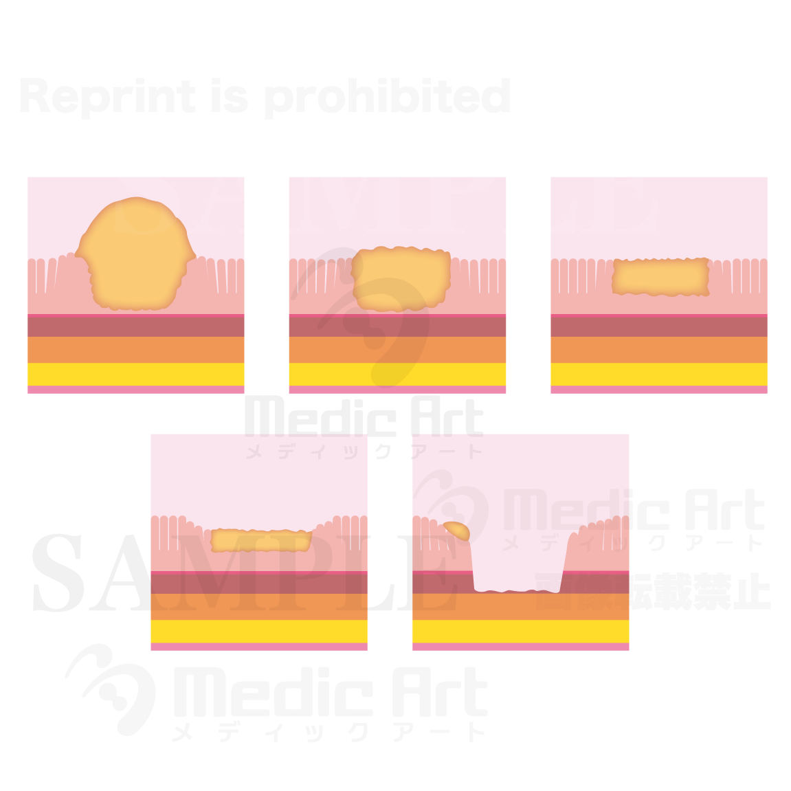Types of early stage stomach cancer