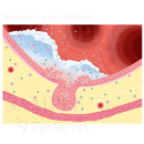 気管支喘息（ぜんそく）のメカニズム（気管支の内部の拡大図）