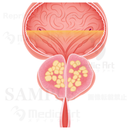 前立腺肥大症