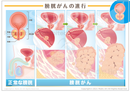 正常な前立腺と膀胱がんの進行［シート］