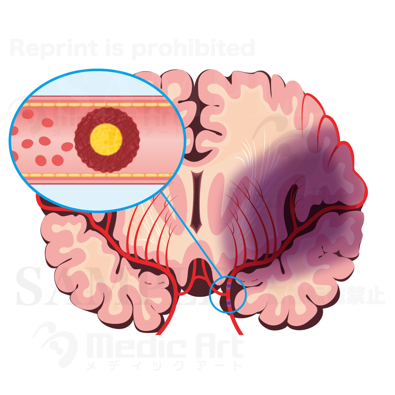 Cerebral infarction : Cardiogenic embolism