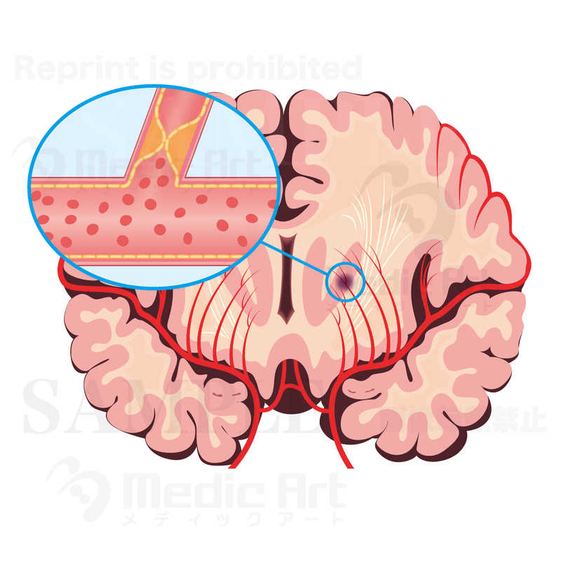 Cerebral infarction : Lacunar infarction