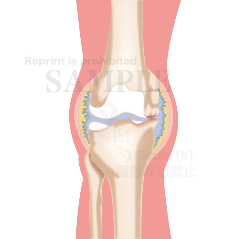 Deformans arthritis