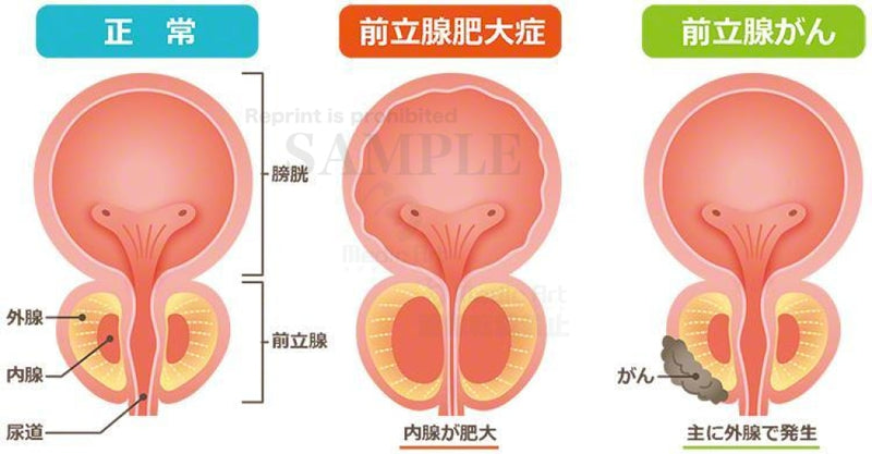 Normal prostate and benign prostatic hyperplasia, the prostate cancer 【with Japanese characters