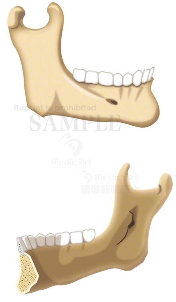下顎骨（かがくこつ）（右側外側面、右側内側面）