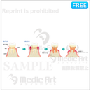 歯周病の進行 ［文字付］