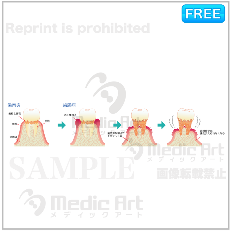 The progression of periodontal disease 【F：with letters