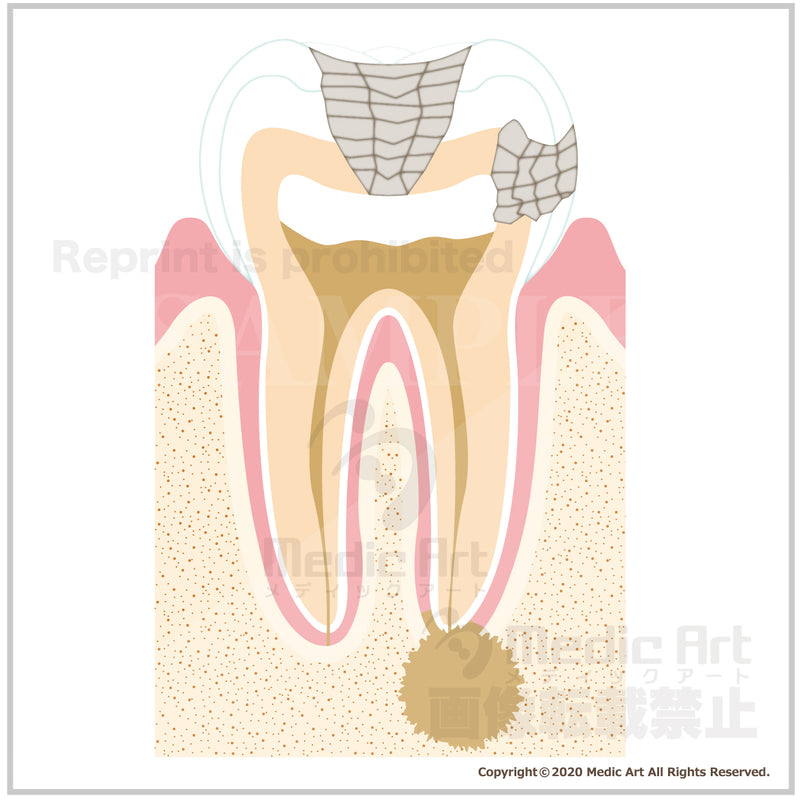 Progression of dental caries and treatmen 3b