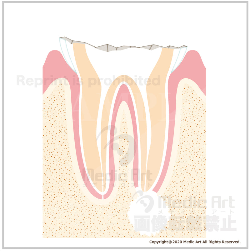 Progression of dental caries and treatmen 4b