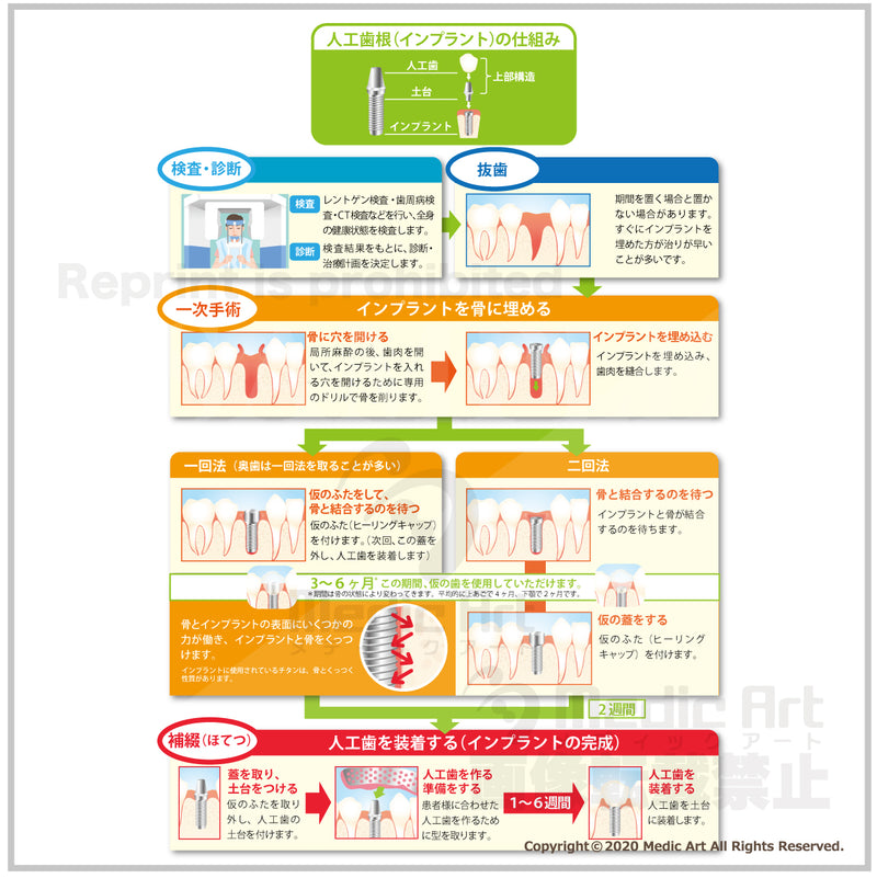 Procedure of implant treatment ［With Japanese characters］