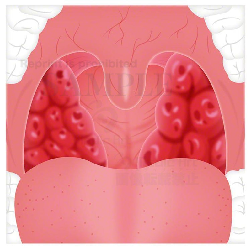 Chronic tonsillitis