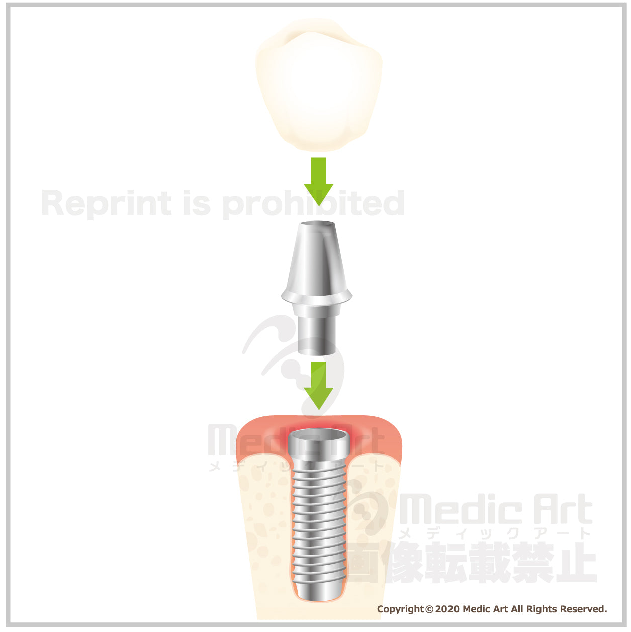 インプラント（人工歯根）のしくみ