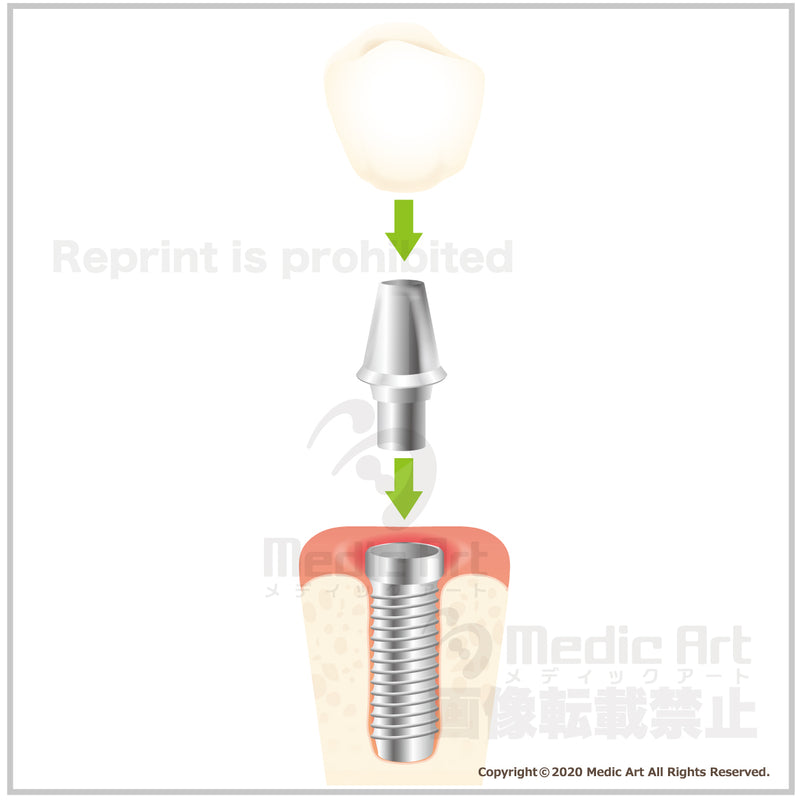 Mechanism of implant (artificial tooth root)