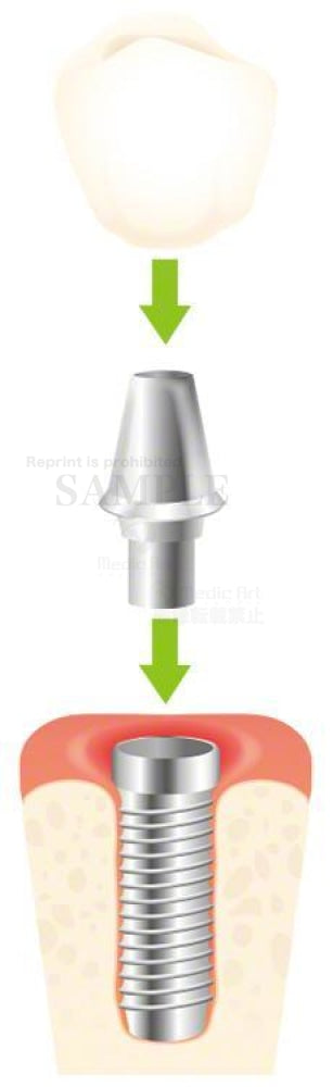 インプラント（人工歯根）のしくみ