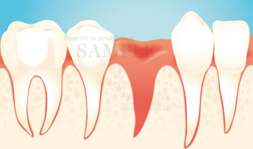 Tooth extraction