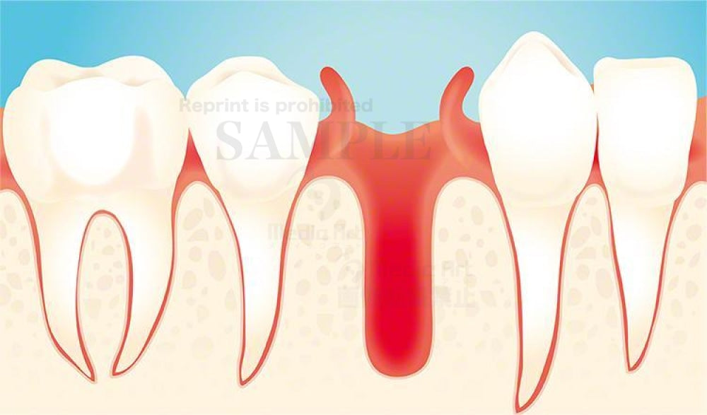 After the tooth extraction, drilling a hole in the bone