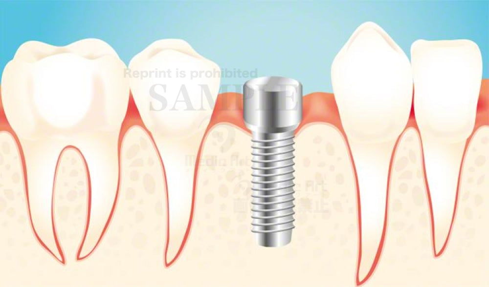 インプラントに仮の蓋をする
