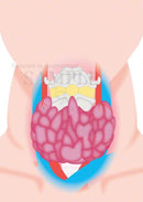 甲状腺機能更新症（バセドウ病）