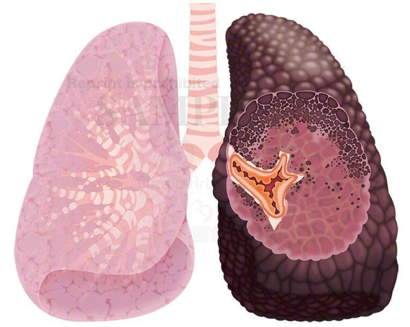 Copdchronic Obstructive Pulmonary Disease