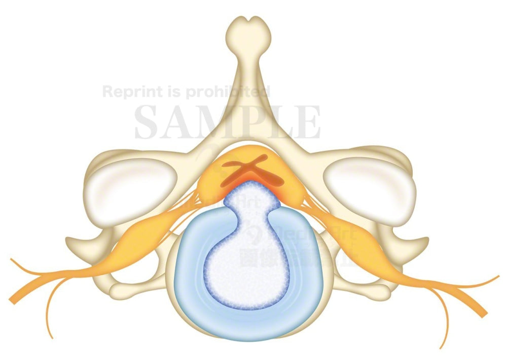 Cervical of disc herniation