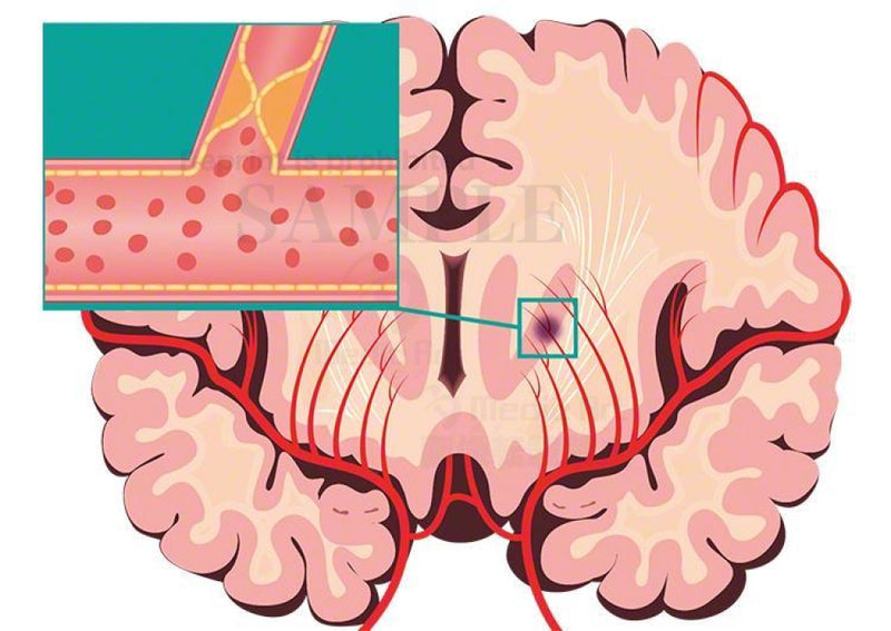 Cerebral infarction : Lacunar infarction