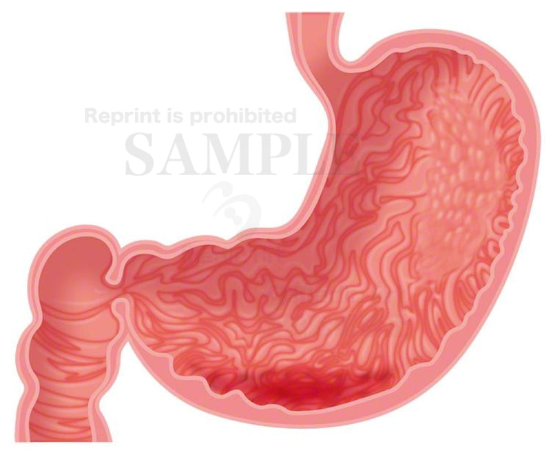 Acute gastritis and chronic gastritis 