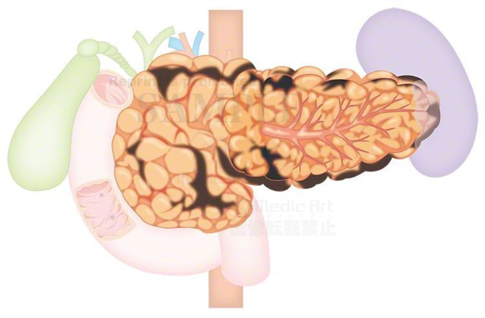 Acute pancreatitis