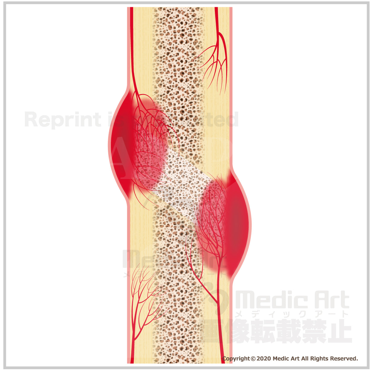A mechanism that bone fracture is healed (2)