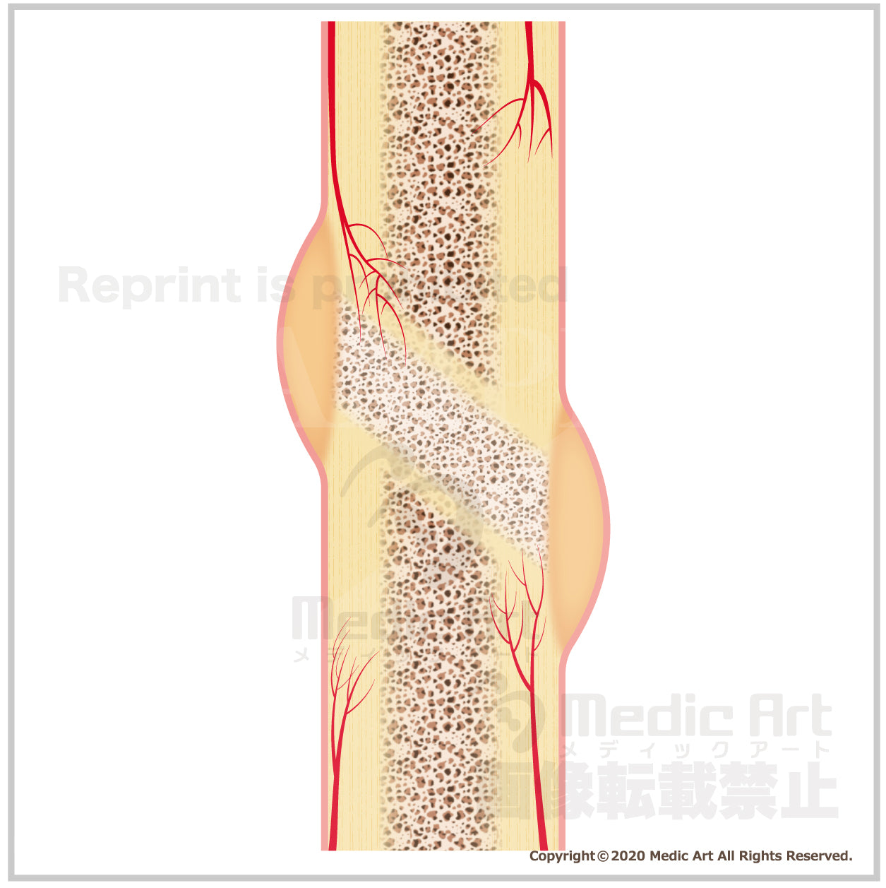 A mechanism that bone fracture is healed (3)