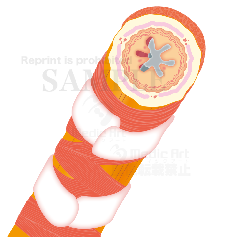 喘息発作を起こしている気管支