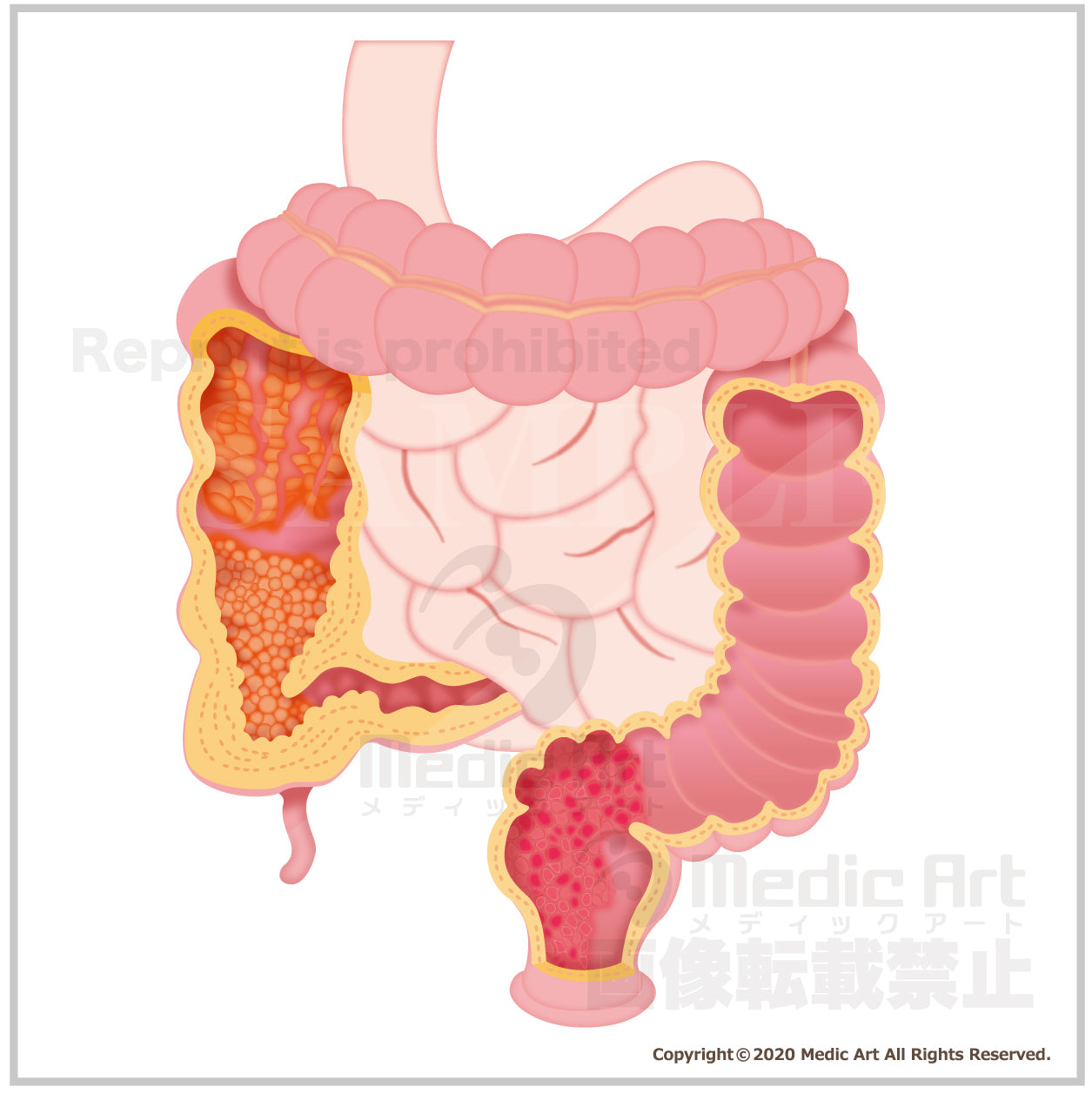 Colitis ulcerosa