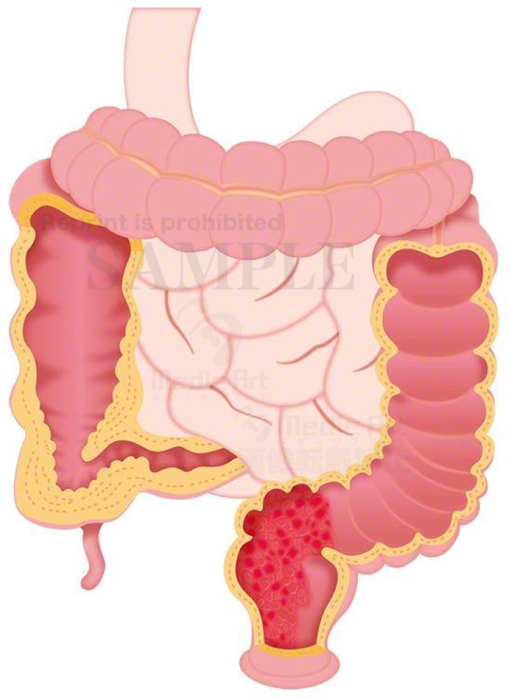 Colitis ulcerosa