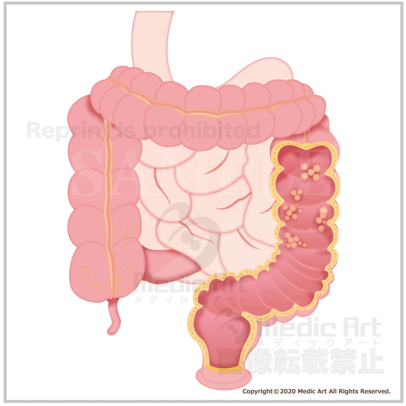 Large intestine polyp