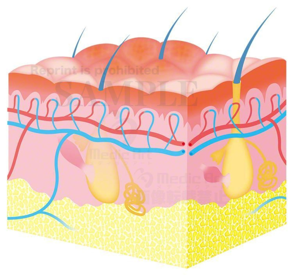 Erythema edema skin