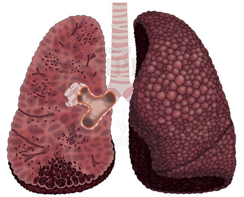 Ipf:idiopathic Pulmonary Fibrosis