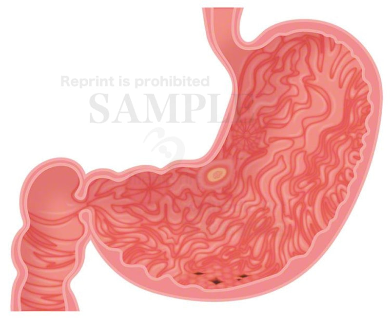 Gastric ulcer