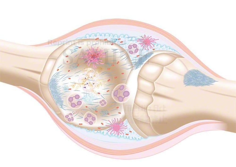 Gout attack