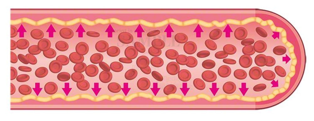 The blood vessel which causes high blood pressure