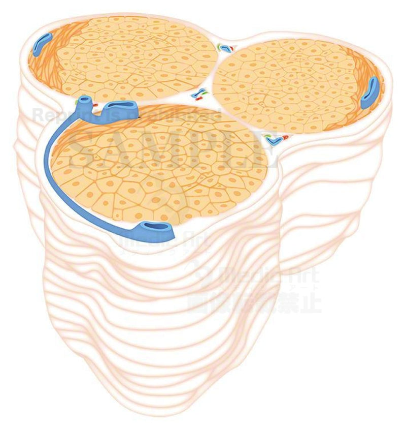 Cirrhosis of the liver(Enlarged focus of disease)　