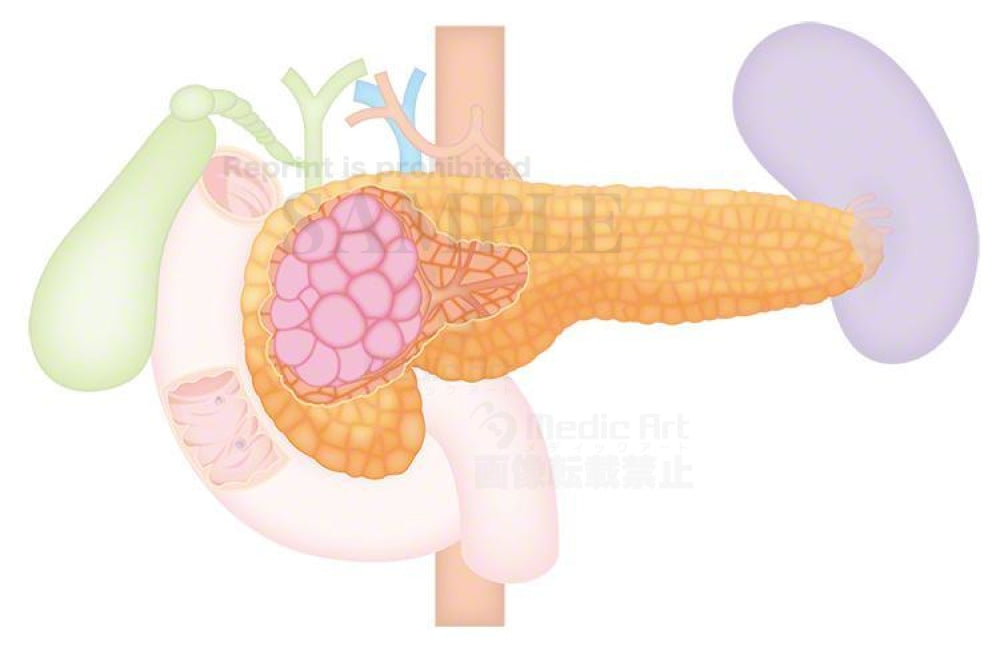 Pancreatic cancer