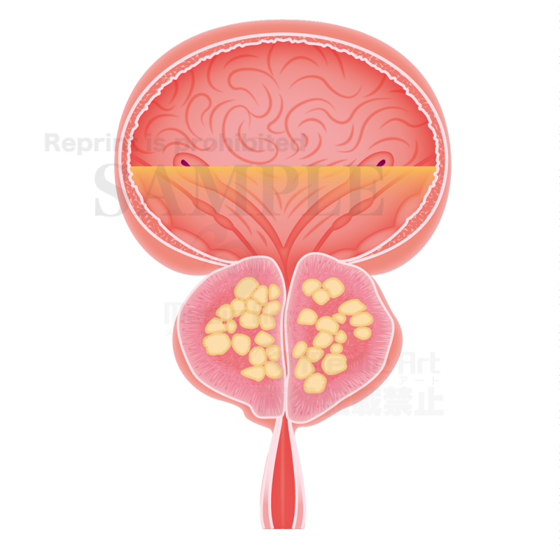 Prostatomegaly