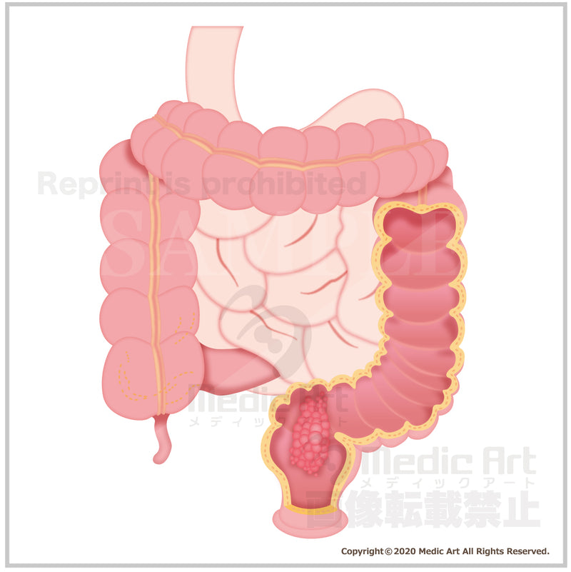 Large intestine polyp