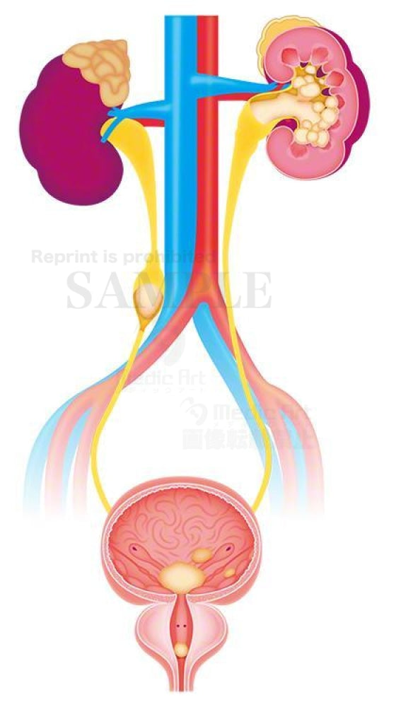 腎臓から尿路に結石ができる病気、尿路結石症