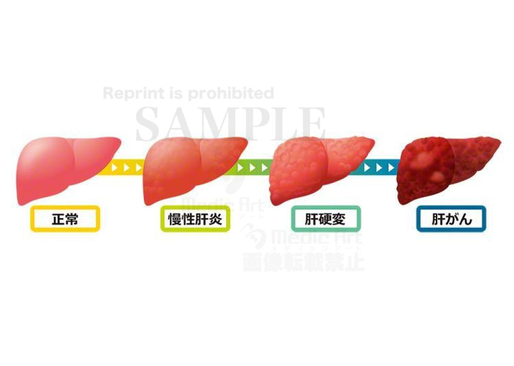 Normal liver, chronic hepatitis, cirrhosis, liver cancer